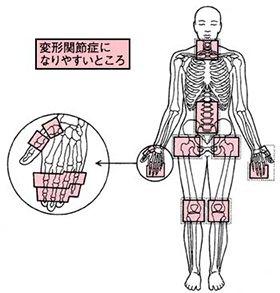変形性関節症はつらい
